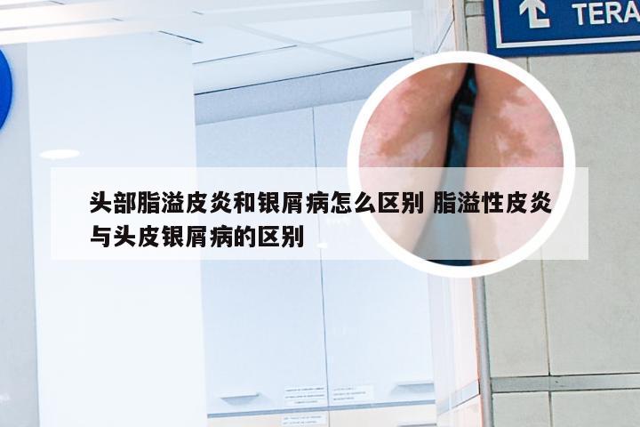头部脂溢皮炎和银屑病怎么区别 脂溢性皮炎与头皮银屑病的区别