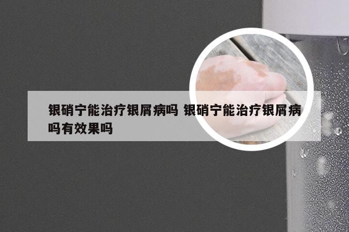 银硝宁能治疗银屑病吗 银硝宁能治疗银屑病吗有效果吗