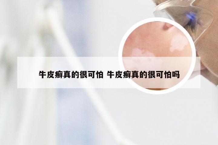 牛皮癣真的很可怕 牛皮癣真的很可怕吗