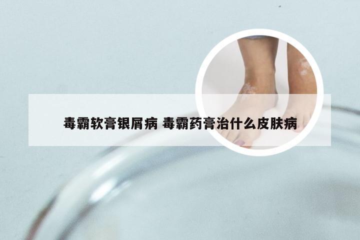 毒霸软膏银屑病 毒霸药膏治什么皮肤病