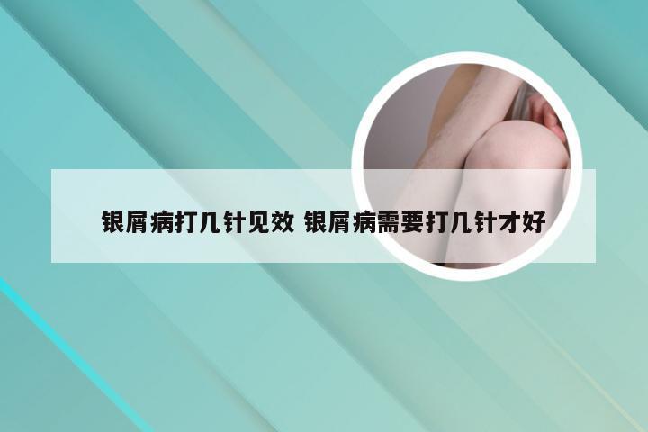 银屑病打几针见效 银屑病需要打几针才好