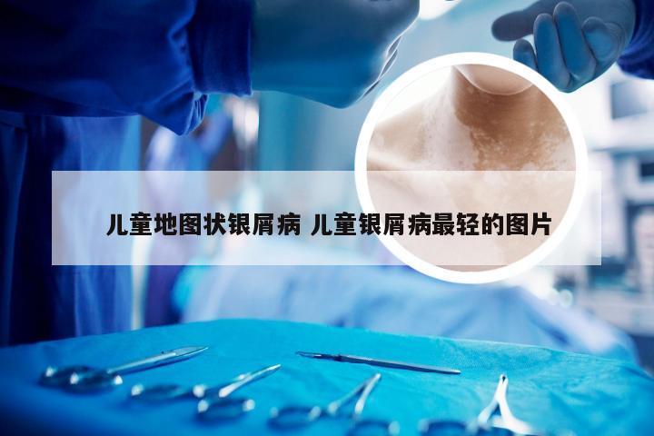 儿童地图状银屑病 儿童银屑病最轻的图片
