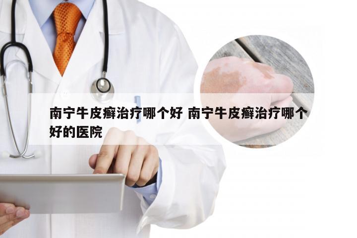 南宁牛皮癣治疗哪个好 南宁牛皮癣治疗哪个好的医院