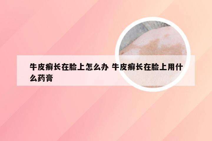 牛皮癣长在脸上怎么办 牛皮癣长在脸上用什么药膏