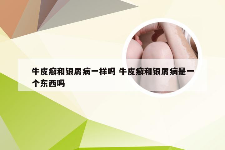牛皮癣和银屑病一样吗 牛皮癣和银屑病是一个东西吗