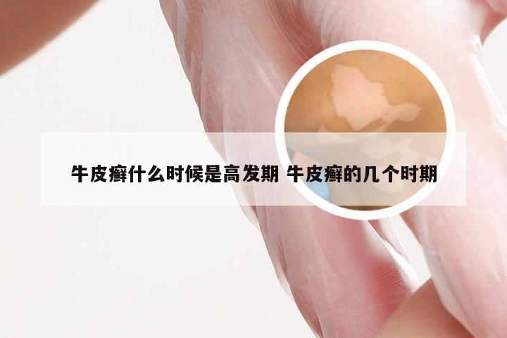 牛皮癣什么时候是高发期 牛皮癣的几个时期