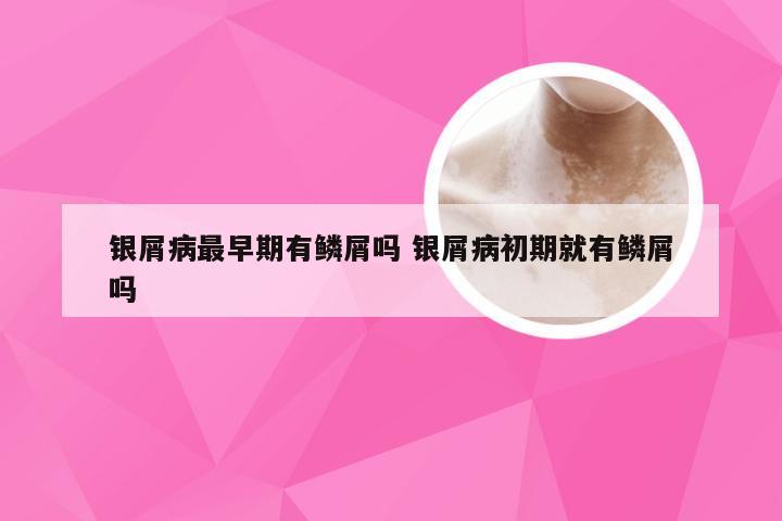 银屑病最早期有鳞屑吗 银屑病初期就有鳞屑吗