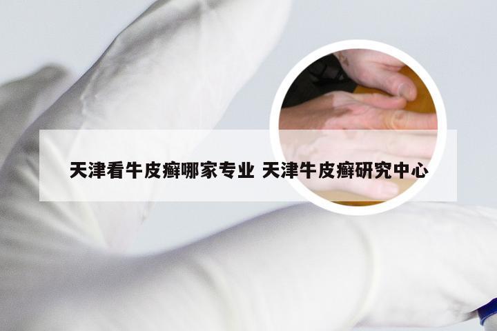 天津看牛皮癣哪家专业 天津牛皮癣研究中心