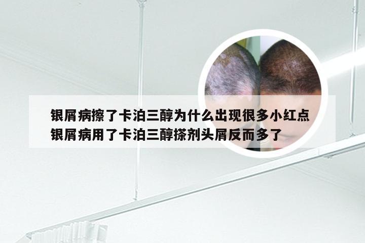银屑病擦了卡泊三醇为什么出现很多小红点 银屑病用了卡泊三醇搽剂头屑反而多了