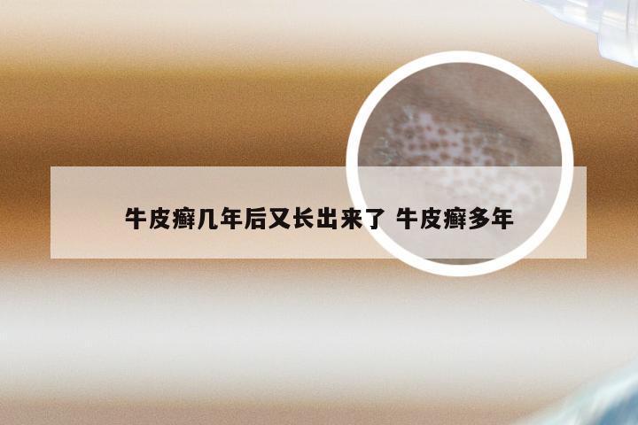 牛皮癣几年后又长出来了 牛皮癣多年