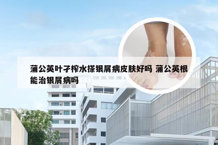 蒲公英叶孑榨水搽银屑病皮肤好吗 蒲公英根能治银屑病吗