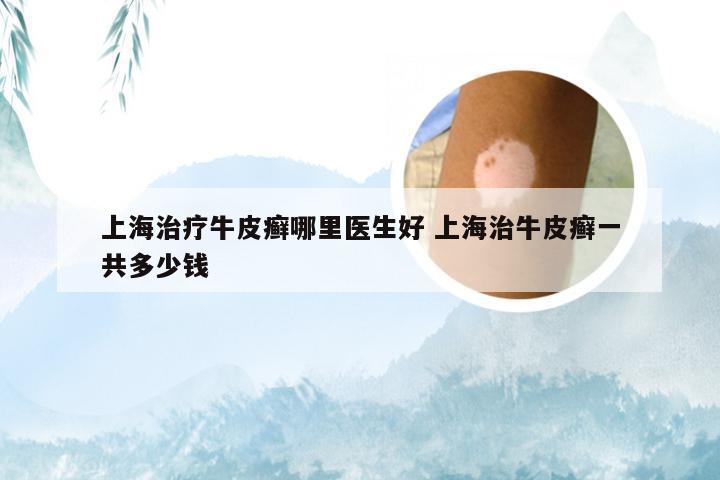 上海治疗牛皮癣哪里医生好 上海治牛皮癣一共多少钱