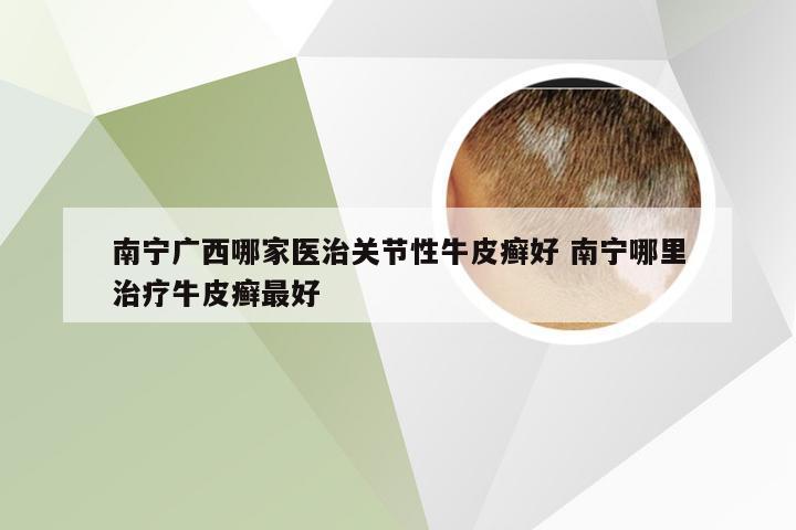 南宁广西哪家医治关节性牛皮癣好 南宁哪里治疗牛皮癣最好