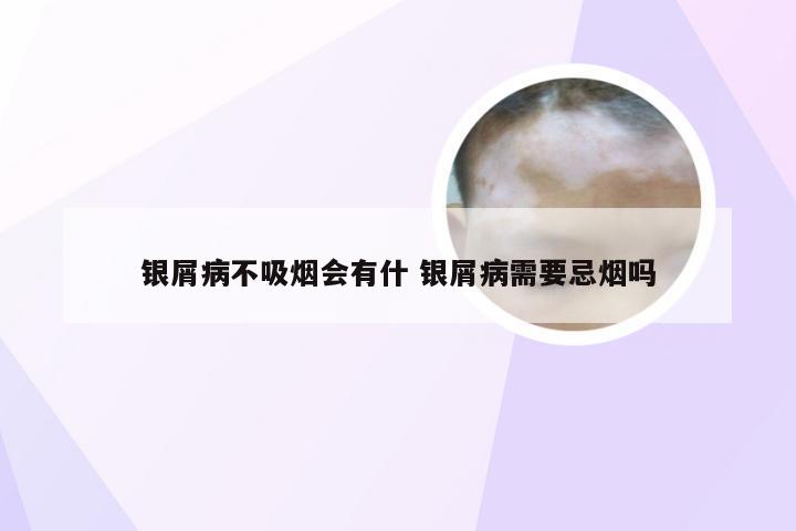 银屑病不吸烟会有什 银屑病需要忌烟吗