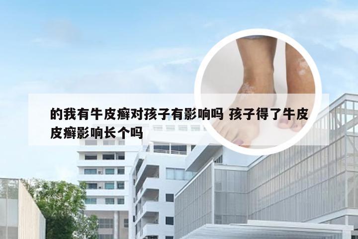 的我有牛皮癣对孩子有影响吗 孩子得了牛皮皮癣影响长个吗
