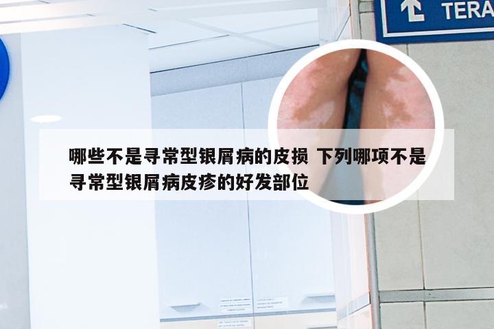 哪些不是寻常型银屑病的皮损 下列哪项不是寻常型银屑病皮疹的好发部位