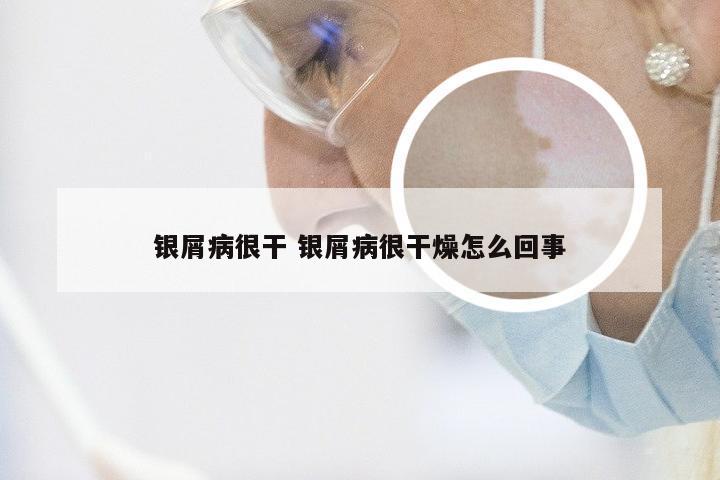 银屑病很干 银屑病很干燥怎么回事