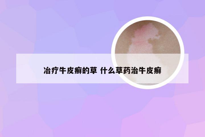 冶疗牛皮癣的草 什么草药治牛皮癣