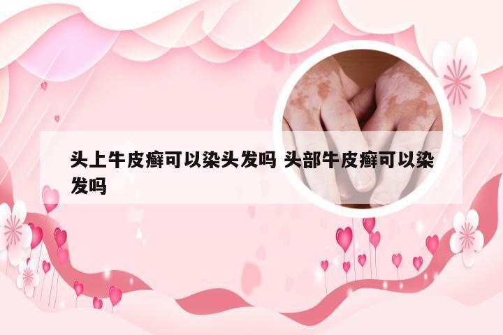 头上牛皮癣可以染头发吗 头部牛皮癣可以染发吗
