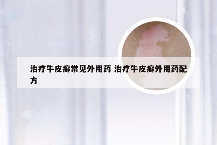 治疗牛皮癣常见外用药 治疗牛皮癣外用药配方