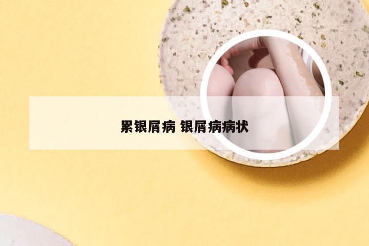 累银屑病 银屑病病状