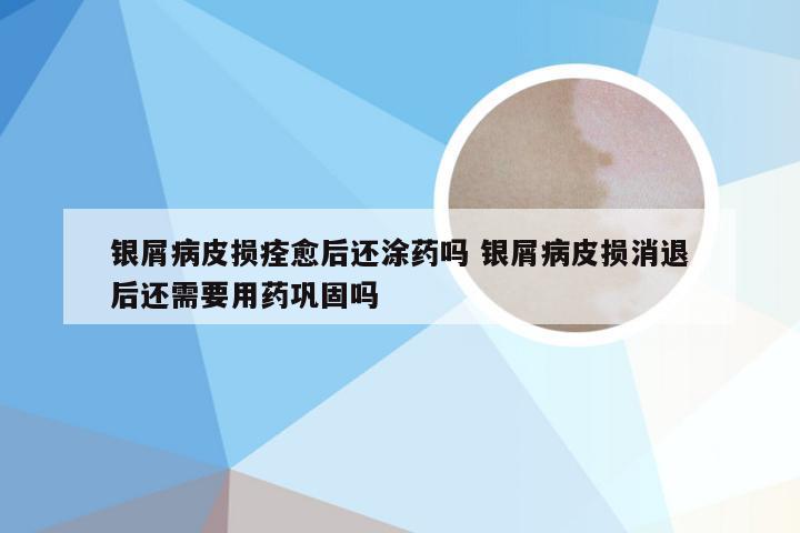 银屑病皮损痊愈后还涂药吗 银屑病皮损消退后还需要用药巩固吗