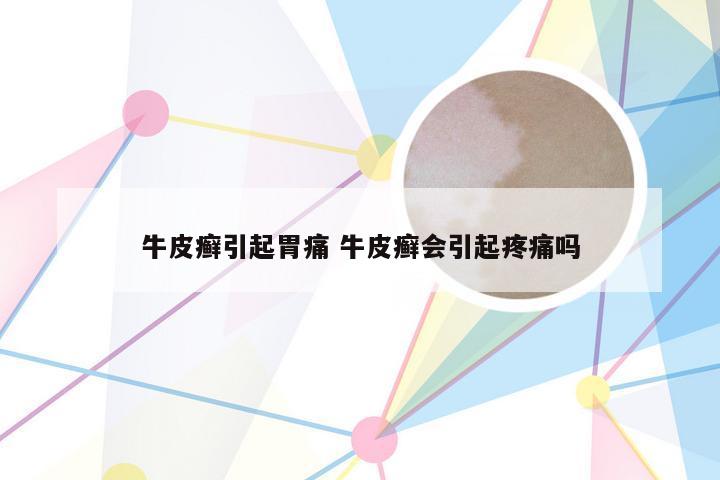 牛皮癣引起胃痛 牛皮癣会引起疼痛吗
