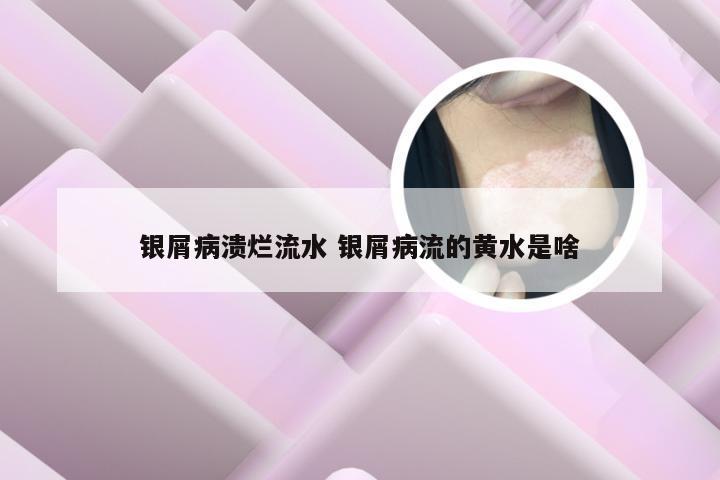 银屑病溃烂流水 银屑病流的黄水是啥