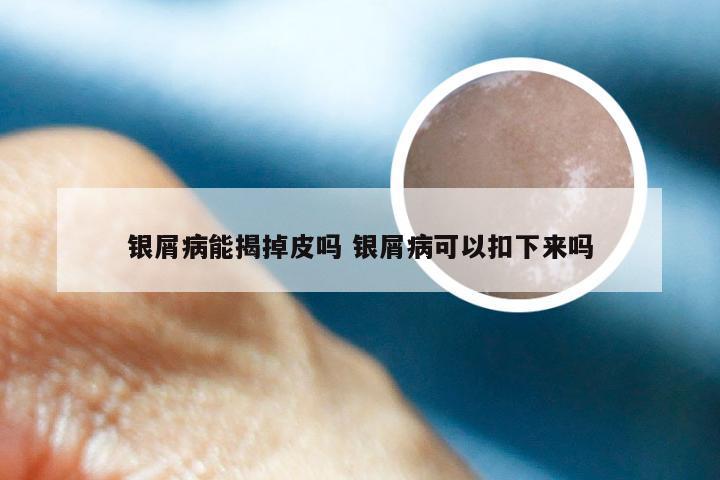 银屑病能揭掉皮吗 银屑病可以扣下来吗