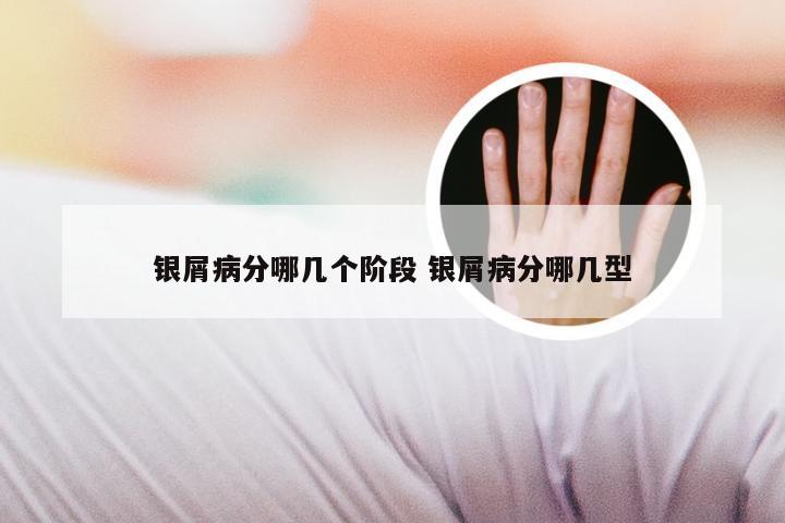 银屑病分哪几个阶段 银屑病分哪几型
