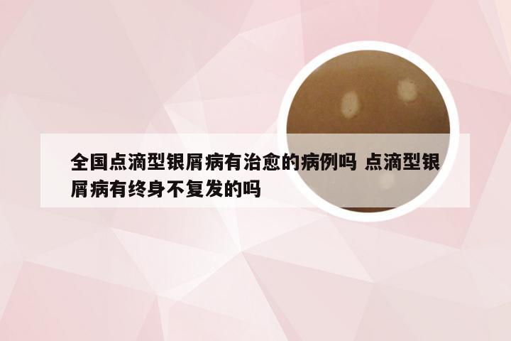 全国点滴型银屑病有治愈的病例吗 点滴型银屑病有终身不复发的吗