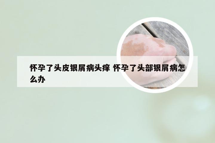 怀孕了头皮银屑病头痒 怀孕了头部银屑病怎么办