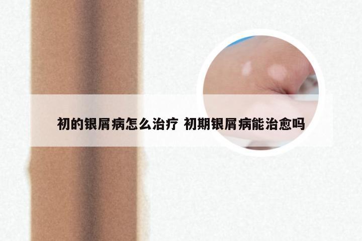 初的银屑病怎么治疗 初期银屑病能治愈吗