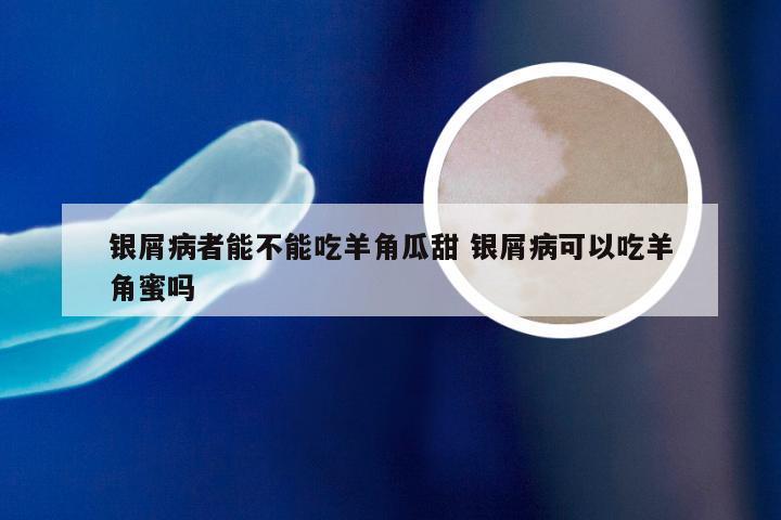 银屑病者能不能吃羊角瓜甜 银屑病可以吃羊角蜜吗