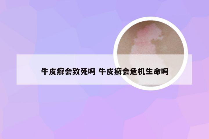 牛皮癣会致死吗 牛皮癣会危机生命吗