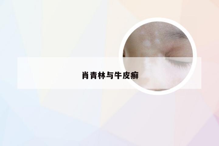 肖青林与牛皮癣