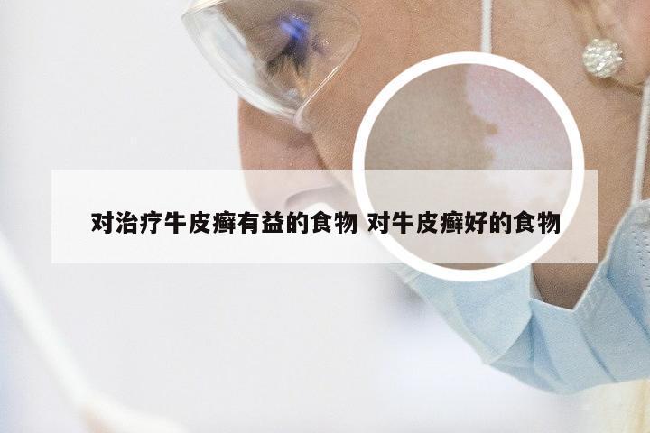 对治疗牛皮癣有益的食物 对牛皮癣好的食物