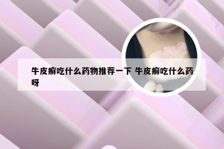 牛皮癣吃什么药物推荐一下 牛皮癣吃什么药呀