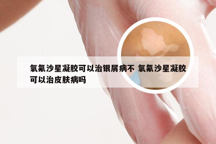 氧氟沙星凝胶可以治银屑病不 氧氟沙星凝胶可以治皮肤病吗