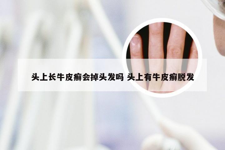头上长牛皮癣会掉头发吗 头上有牛皮癣脱发