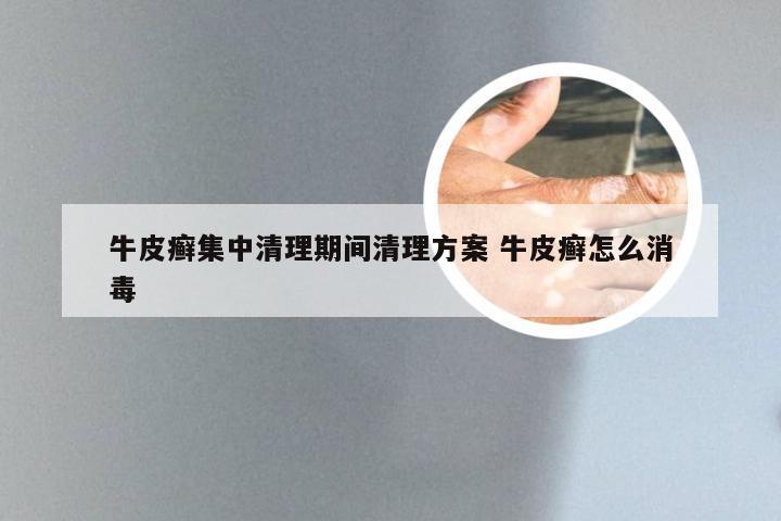 牛皮癣集中清理期间清理方案 牛皮癣怎么消毒