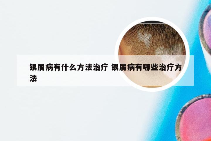 银屑病有什么方法治疗 银屑病有哪些治疗方法