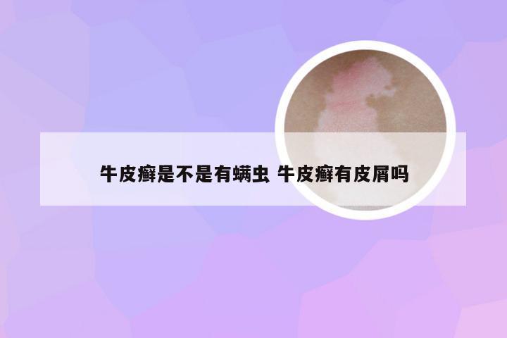 牛皮癣是不是有螨虫 牛皮癣有皮屑吗