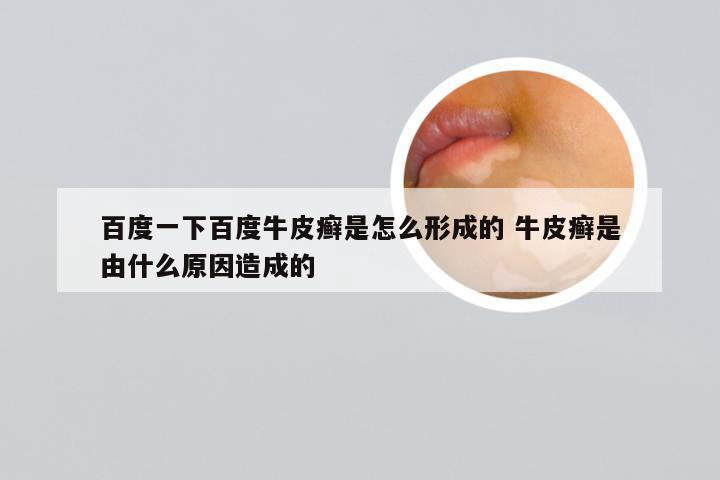 百度一下百度牛皮癣是怎么形成的 牛皮癣是由什么原因造成的