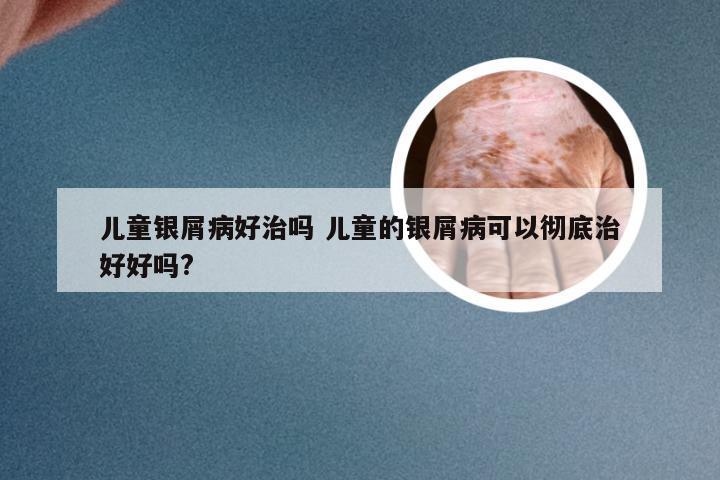 儿童银屑病好治吗 儿童的银屑病可以彻底治好好吗?