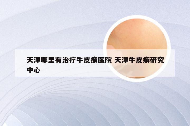 天津哪里有治疗牛皮癣医院 天津牛皮癣研究中心