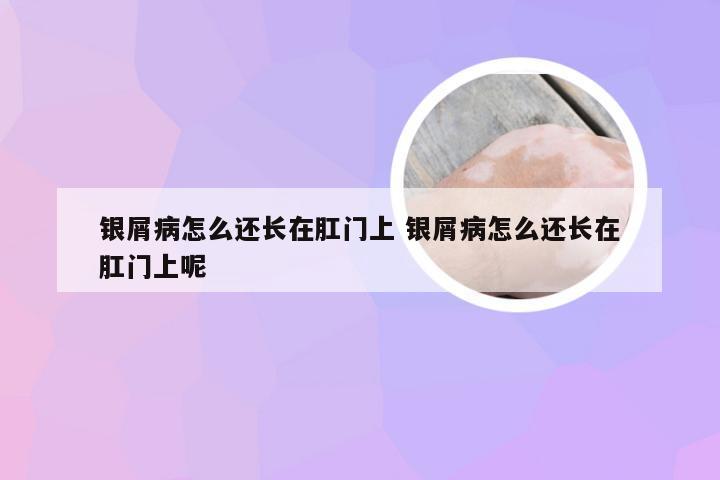 银屑病怎么还长在肛门上 银屑病怎么还长在肛门上呢