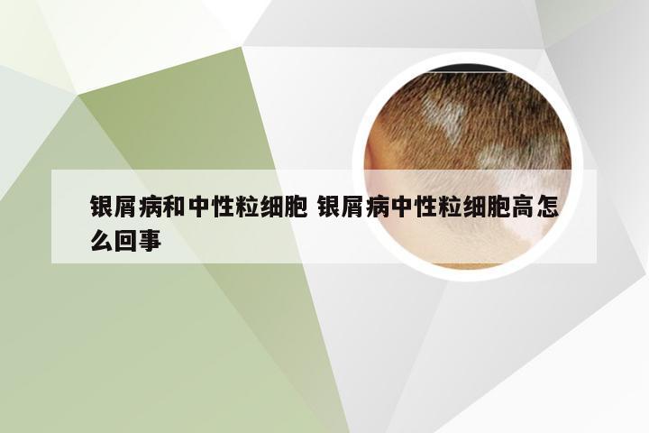 银屑病和中性粒细胞 银屑病中性粒细胞高怎么回事