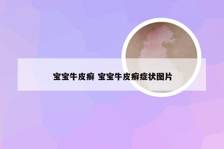 宝宝牛皮癣 宝宝牛皮癣症状图片