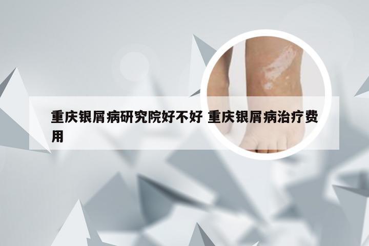 重庆银屑病研究院好不好 重庆银屑病治疗费用